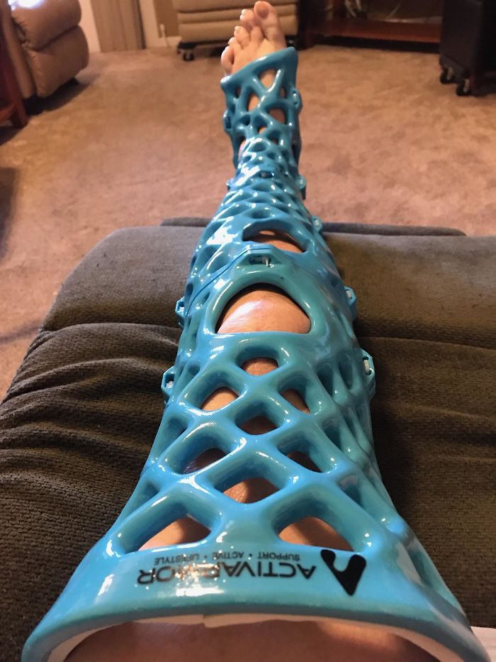 https://www.awesomeinventions.com/wp-content/uploads/2019/06/3d-printing-brilliant-creations-leg-cast.jpg